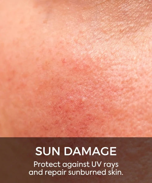 Sun Damage